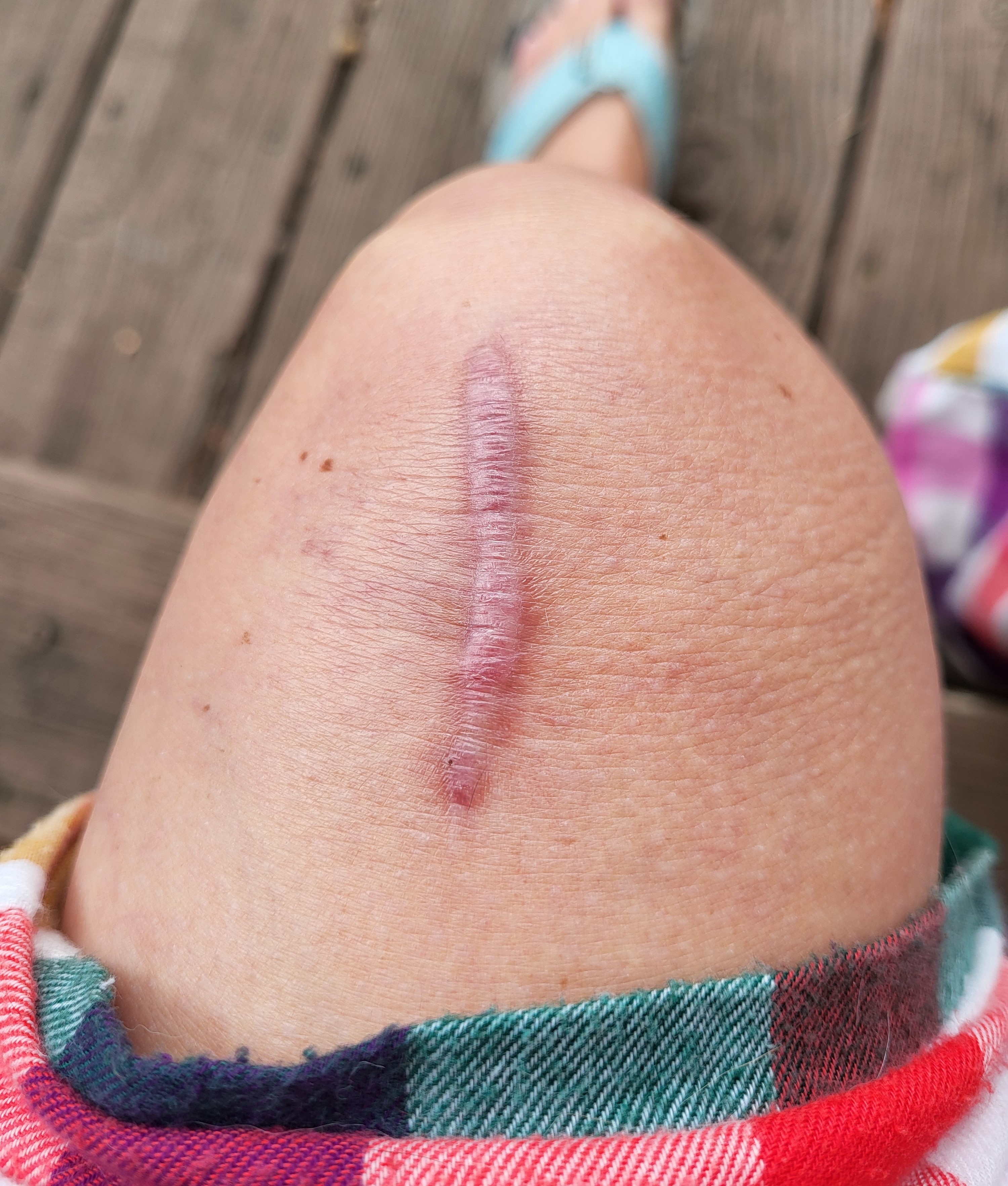 Leg lamentations